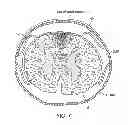 Fig. 09 - Electrode array device configured for placement inside the dura for direct spinal cord stimulation