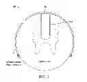 Fig. 11 - Electrode array device configured for placement inside the dura for direct spinal cord stimulation