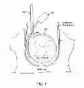 Fig. 13 - Electrode array device configured for placement inside the dura for direct spinal cord stimulation