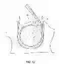 Fig. 14 - Electrode array device configured for placement inside the dura for direct spinal cord stimulation