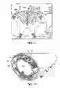 Fig. 26 - Electrode array device configured for placement inside the dura for direct spinal cord stimulation
