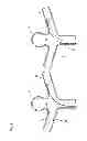 Fig. 19 - Endovascular prosthesis and delivery device