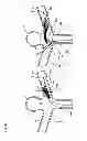Fig. 21 - Endovascular prosthesis and delivery device