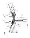 Fig. 22 - Endovascular prosthesis and delivery device