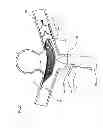 Fig. 23 - Endovascular prosthesis and delivery device