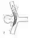 Fig. 24 - Endovascular prosthesis and delivery device