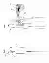 Fig. 27 - Endovascular prosthesis and delivery device