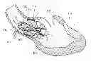 Fig. 01 - Support stent for transvalvular conduit