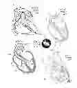 Fig. 02 - Support stent for transvalvular conduit