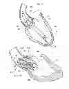 Fig. 04 - Support stent for transvalvular conduit