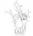 Fig. 01 - Apparatus and method for heart valve repair