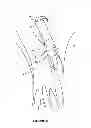 Fig. 06 - Apparatus and method for heart valve repair
