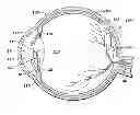 Fig. 01 - Aspherical multifocal intraocular lens
