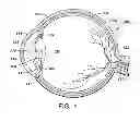 Fig. 02 - Aspherical multifocal intraocular lens
