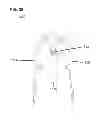 Fig. 31 - Implants for spinal therapy