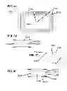 Fig. 35 - Implants for spinal therapy