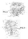 Fig. 03 - Rotatable reverse metaglene kit
