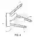 Fig. 04 - Rotatable reverse metaglene kit