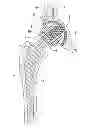 Fig. 01 - Interlocking reverse shoulder prosthesis method
