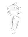 Fig. 02 - Interlocking reverse shoulder prosthesis method