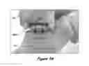Fig. 46 - Joint Arthroplasty Systems, Methods, and Components
