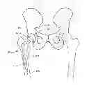 Fig. 01 - Methods and devices for a surgical hip replacement procedure