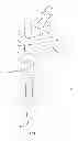 Fig. 03 - Methods and devices for a surgical hip replacement procedure