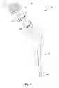 Fig. 05 - Methods and devices for a surgical hip replacement procedure