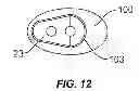 Fig. 11 - Methods and devices for a surgical hip replacement procedure
