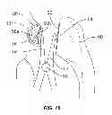 Fig. 14 - Methods and devices for a surgical hip replacement procedure