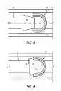Fig. 03 - Self-energized seal or centralizer and associated setting and retraction mechanism