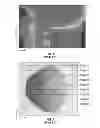 Fig. 04 - Method and system of measuring anatomical features in subcutaneous images to assess risk of injury