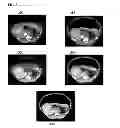 Fig. 04 - System and method for registering pre-operative and intra-operative images using biomechanical model simulations