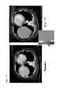 Fig. 04 - Methods of treating neuroendocrine tumors using frizzled-binding agents