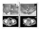 Fig. 01 - EGFR targeted therapy