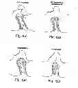 Fig. 13 - BIOLOGIC REPLACEMENT FOR FIBRIN CLOT
