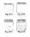 Fig. 17 - BIOLOGIC REPLACEMENT FOR FIBRIN CLOT