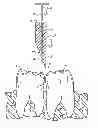 Fig. 01 - Interproximal non-surgical caries treatment method