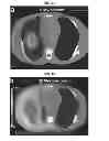 Fig. 03 - Pluridirectional very high electron energy radiation therapy systems and processes