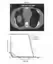Fig. 04 - Pluridirectional very high electron energy radiation therapy systems and processes