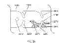 Fig. 33 - Controlling magnetic nanoparticles to increase vascular flow