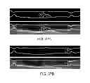 Fig. 46 - Controlling magnetic nanoparticles to increase vascular flow
