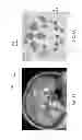 Fig. 04 - Enhanced Spatial Summation for Deep-Brain Transcranial Magnetic Stimulation