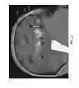 Fig. 06 - Enhanced Spatial Summation for Deep-Brain Transcranial Magnetic Stimulation