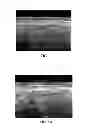 Fig. 08 - Methods, systems, and media for determining carotid intima-media thickness