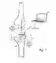 Fig. 02 - Prosthetic component having a compliant surface