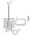 Fig. 22 - Methods for injecting a drug into prostate tissue