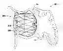 Fig. 01 - LEFT ATRIAL APPENDAGE CLOSURE IMPLANT