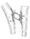 Fig. 01 - Multi-layer braided structures for occluding vascular defects