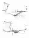 Fig. 09 - Multi-layer braided structures for occluding vascular defects